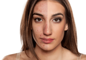 Maquiagem para pele com acne